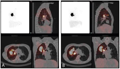 Feasibility of Non-Invasive Sentinel Lymph Node Identification in Early ...