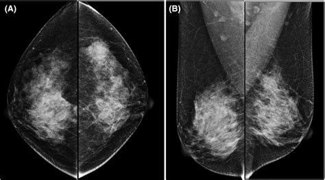 Phyllodes Tumor Growth Rate