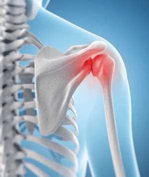 Frozen Shoulder