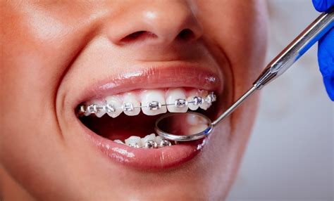 Image result for braces