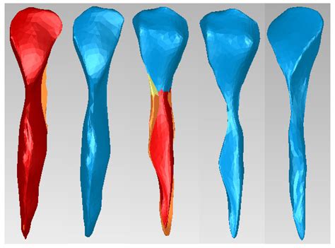 Simulation of an Orthodontic System Using the Lingual Technique Based ...