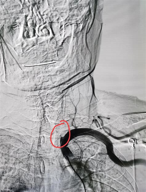 Consultation of a patient with dizziness and blurred vision - iNEWS