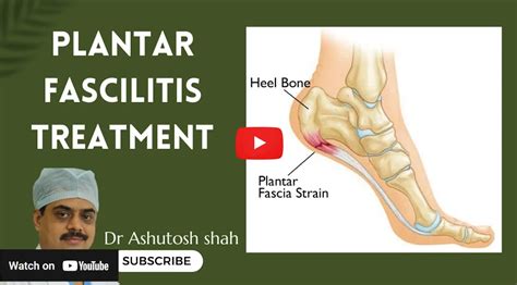 Get Relief from Plantar Fasciitis Pain | Expert Treatment