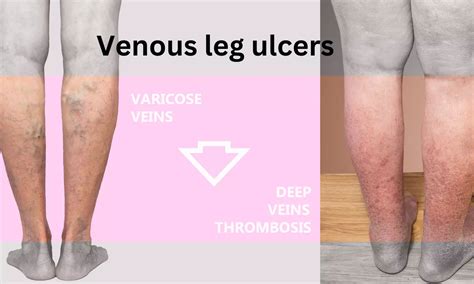 Combined endovenous ablation and compression may speed up venous leg ...
