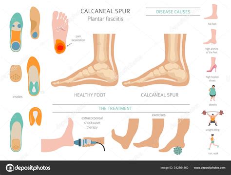 Plantar calcaneal spur treatment. Heel Spur Treatment: Causes, Symptoms, and Effective Solutions