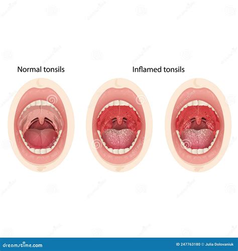 Healthy Normal Tonsils