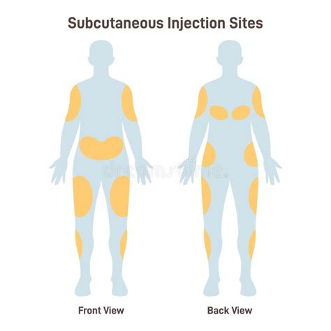 Subcutaneous Injection Sites. Medicine Injection Sites on the Human Body Stock Vector ...