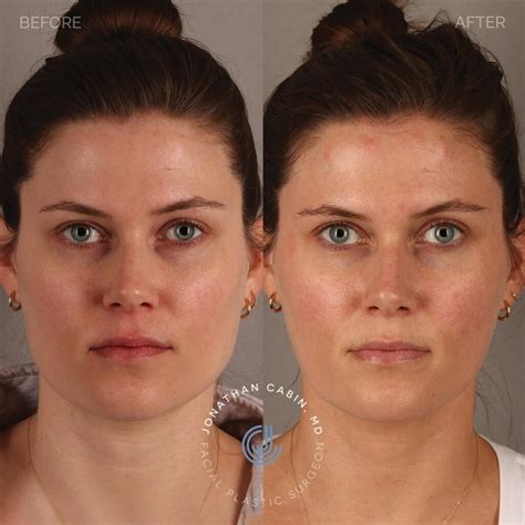 Masseter (TMJ) Botox / Non-Surgical Facial Slimming - Dr. Jonathan Cabin