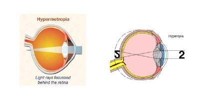 Refractive errors-Sri Venkateshwara nethralaya- Eye-hospital ...