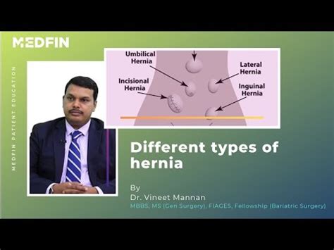 Videos about Hiatal Hernia Treatment/Surgery - Medfin