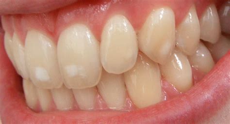 Image result for Calcium Buildup Front Teeth