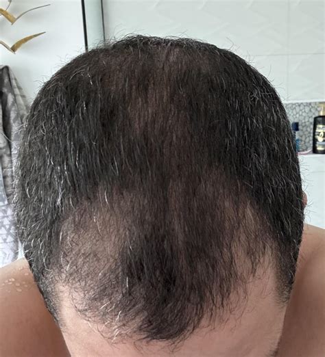 Diffuse Thinning - Surgery Next Week : r/Hairtransplant
