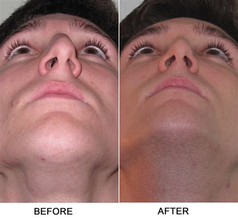 Nasal septum anatomy, function, nasal septum deviation & hole