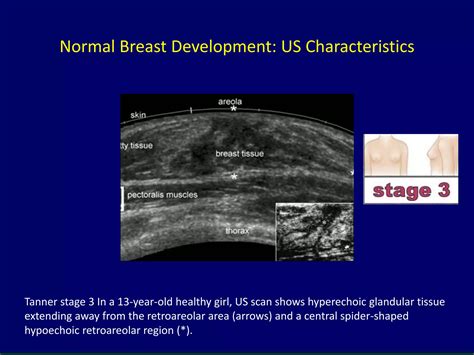 Ultrasound of pediatric and adolescent breast | PPTX