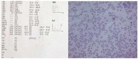 A comparative study of red cell histogram along with CBC parameters and ...
