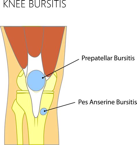 Knee Bursitis — Adam B. Cohen, MD