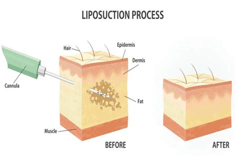 Jawline Liposuction Hits The Right Spot Between Fillers And Facelifts ...