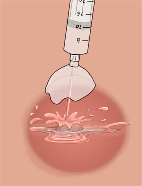 Carbuncle Drainage Procedure 的图像结果