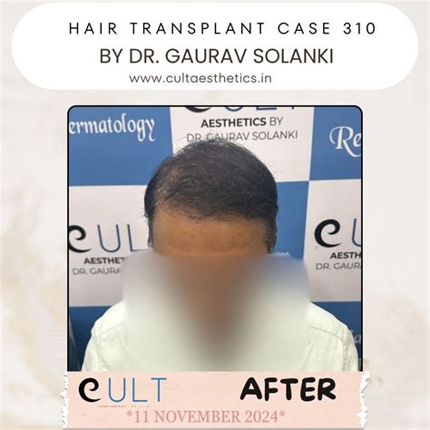 Hair Transplant Results 310 | Cult Aesthetics
