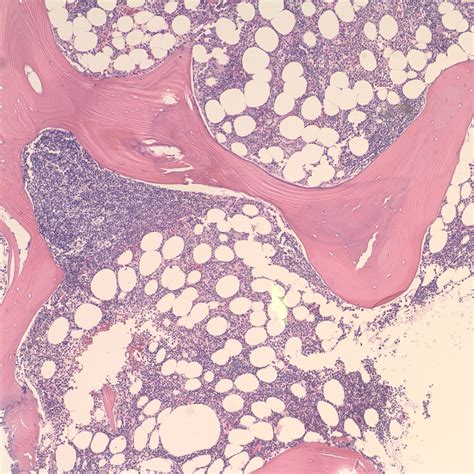 Pathology Outlines - Splenic marginal zone lymphoma