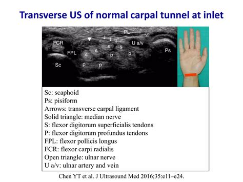 Ultrasound of carpal tunnel syndrome | PPTX