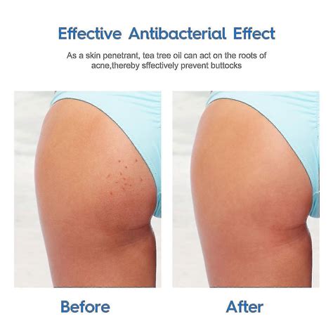Butt Acne Clearing Cream Removing Pimples Balance Skin Moisturizing Treatment1pc | Fruugo UK