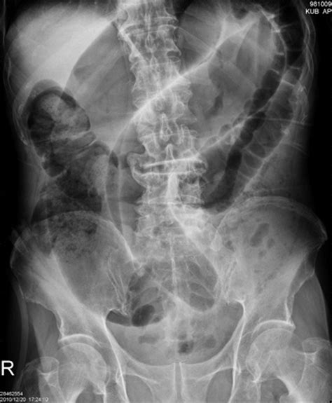 Cecal Volvulus Coffee Bean Sign