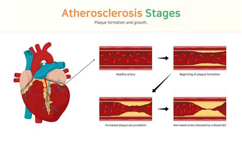 Atherosclerosis Stages