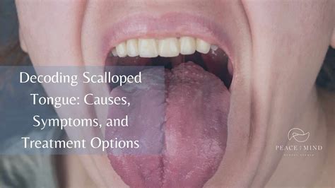 Tongue Scalloped Hypothyroidism The Clinical Picture Of Hypothyroidism