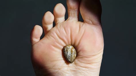 How To Get Rid Of Plantar Warts On Hands - Infoupdate.org