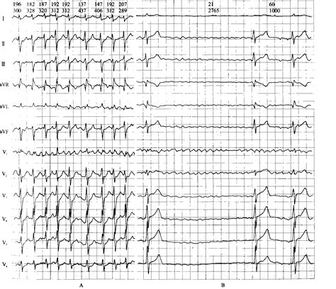8-66 快速型心房颤动伴心室长间歇-心血管-医学