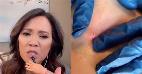 Image result for Exploding Pimple Popper