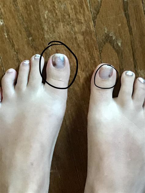 Possible melanoma under toenail? : r/Melanoma