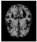 MRI-Driven Alzheimer’s Disease Diagnosis Using Deep Network Fusion and ...