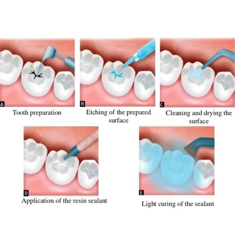 Buy Kids-e-Pit and Fissure Sealant – Oralkart