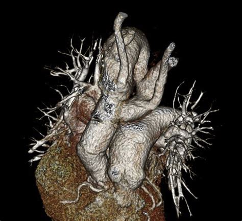 Successful Repair of Type A Aortic Dissection in an Octogenarian With Double Aortic Arch - The ...