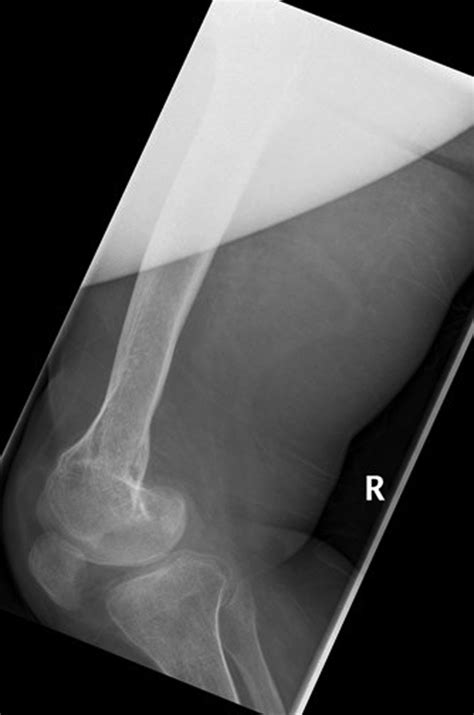 Isolated lower limb hypoplasia secondary to congenital varicella ...