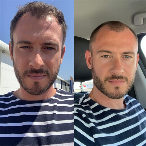 Buzzed Hair Receding Hairline at Clinton Richardson blog