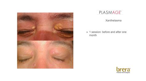 Plasmage | Leader Healthcare India