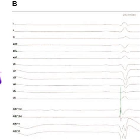 Image result for PVC Localization