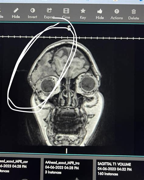 I (30F) was diagnosed with expansile craniofacial fibrous dysplasia on ...