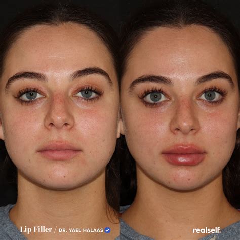 Lips After Lip Filler