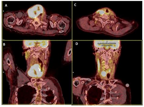 Anaplastic Thyroid Carcinoma: An Update