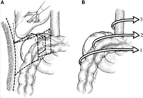 Image result for Flank Incision Nephrectomy