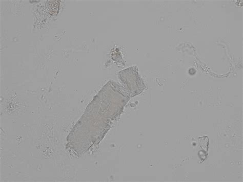 Waxy cast | CellWiki