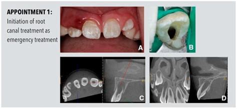 Root Maturation of an Immature Dens Invaginatus Despite Unsuccessful ...