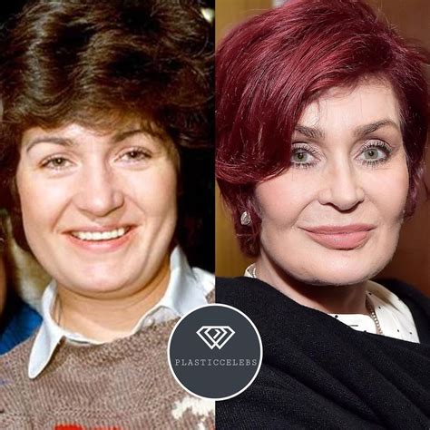 Sharon Osbourne Before And After