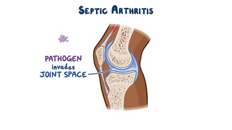 Video: Septic arthritis: Clinical sciences | Osmosis