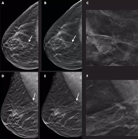 DBT helps in early detection of breast cancer compared to mammography ...