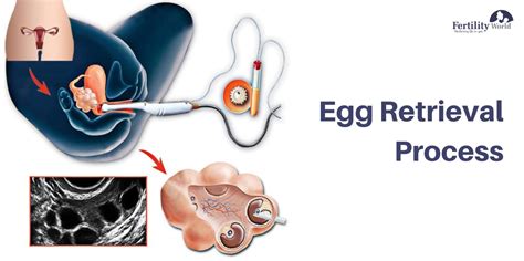 Image result for Egg Freezing Process